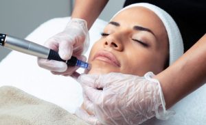 SkinPen medisch microneedling behandeling huid in Huidkliniek Twente