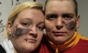 Tatoeage verwijderen