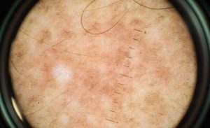 actinische keratose op de huid